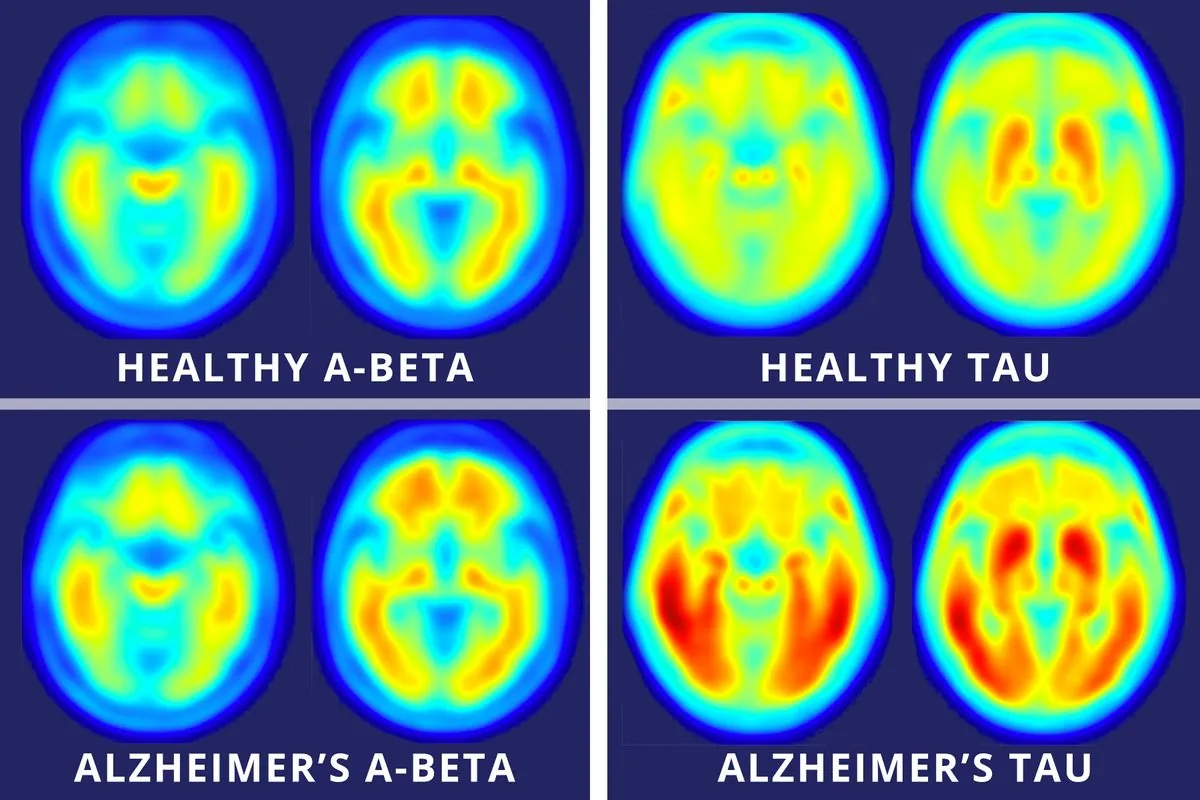 Breakthrough Alzheimer's Drug Lecanemab Set for UK Approval