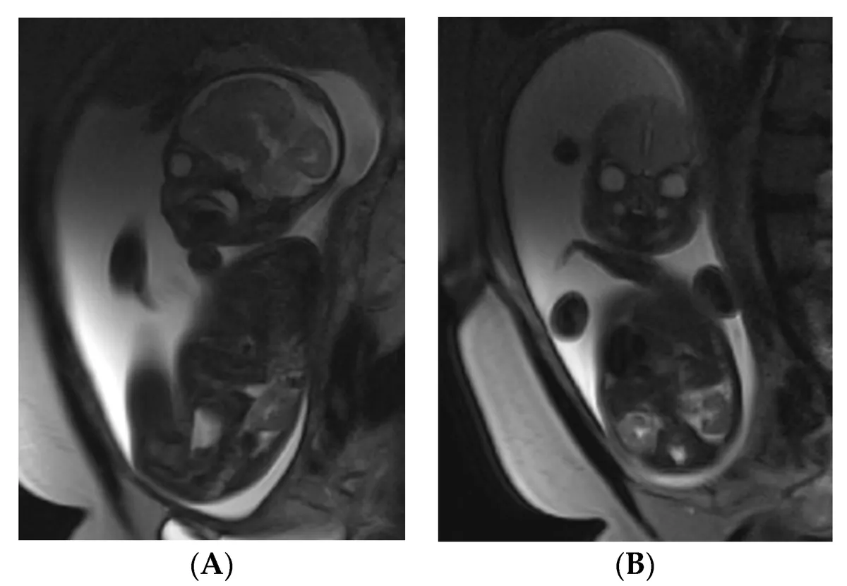 study-reveals-pregnancys-lasting-impact-on-brain-structure