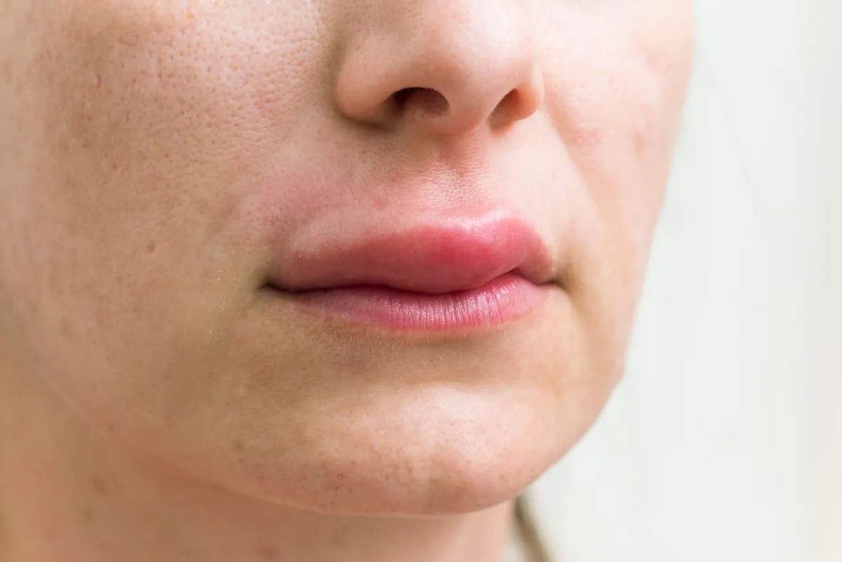 Unraveling the Mystery of Sudden Lip Swelling: Causes and Solutions